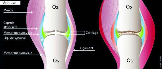 RÃ©sultat de recherche d'images pour "arthrose nouveau traitement 2018"